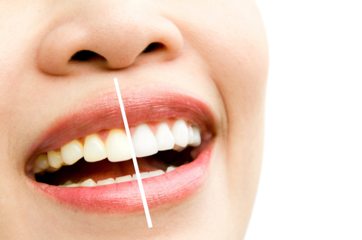 Teeth Whitening & Veneers